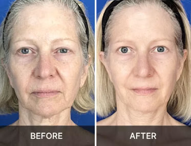 Promotional before and after pair one. Results not typical.